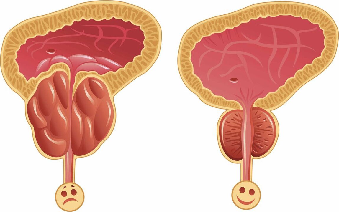 Próstata antes y después del tratamiento con cápsulas Prostaffect