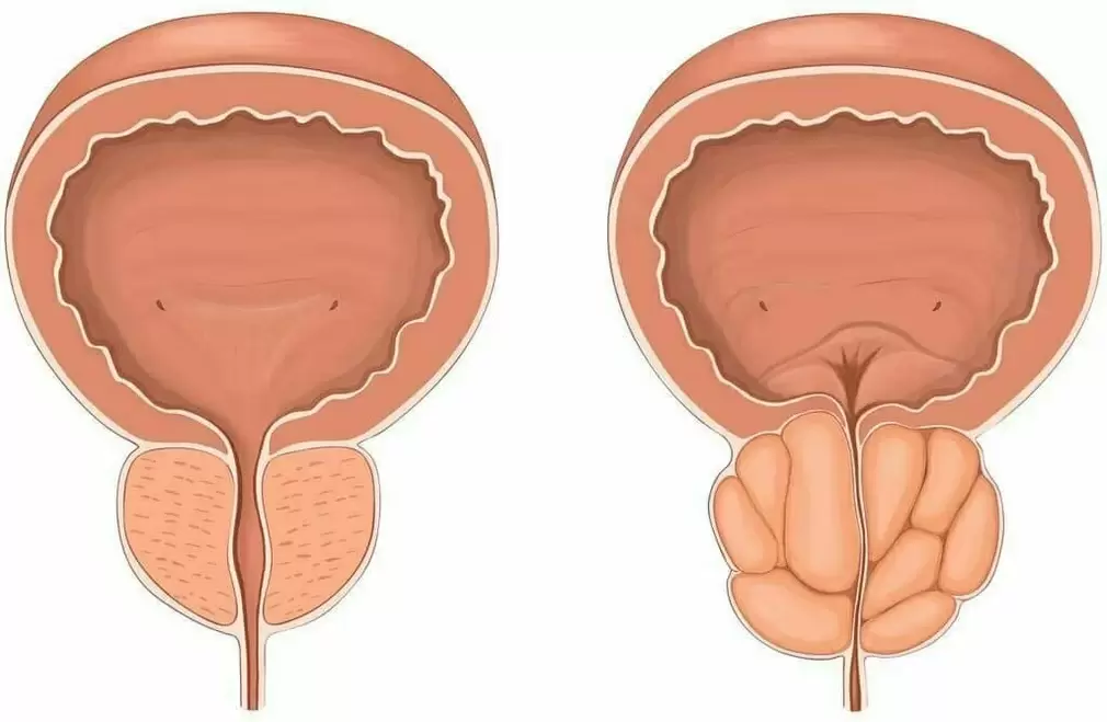 próstata normal y próstata enferma