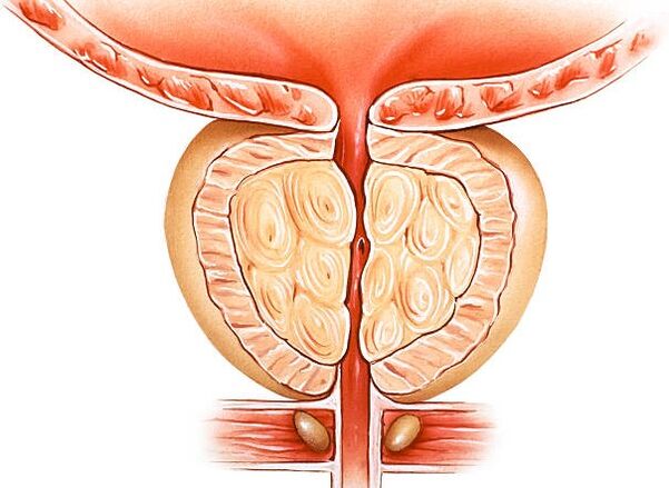 próstata inflamada ilustración